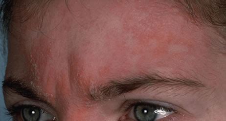 Da die haut um die augen herum sehr empfindlich und dünn ist, wickelt man elemente aus dem kühlfach in ein schützendes tuch. Was hilft bei Neurodemitis auf der Kopfhaut ...