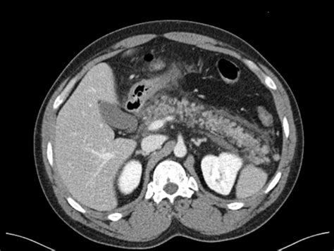 Cureus Covid 19 Necrotizing Pancreatitis And Abdominal Compartment