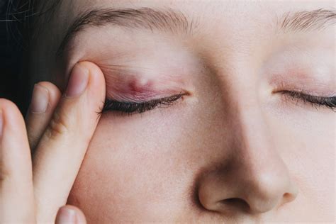 Check spelling or type a new query. What Is This Weird Bump On My Eye? - The Pretty Pimple