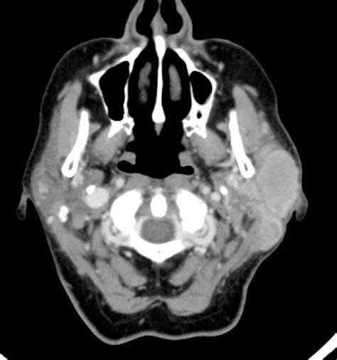 Figure 1 From Imaging Of Lymphomas Of The Head And Neck Semantic Scholar