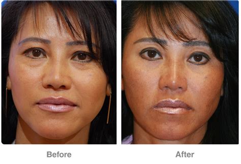 If that hits a nerve, a neck lift may be the answer. Eyelid Cosmetic Surgery (Blepharoplasty) in Corona, Ca