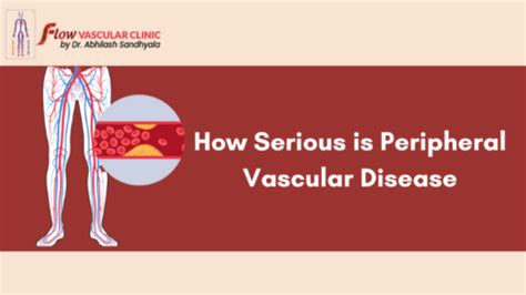 How Serious Is Peripheral Vascular Disease Dr Abhilash