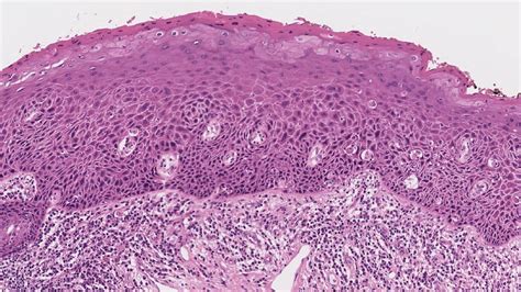 Squamous Cell Carcinoma In Situ Of The Larynx Mypathologyreportca