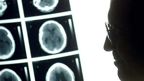 Condenados Por No Extirpar Un Tumor Cerebral A Una Joven A La Que Le