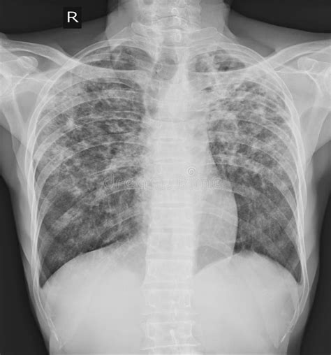 Tb De La Tuberculosis Pulmonar Radiografía Del Pecho Stock De