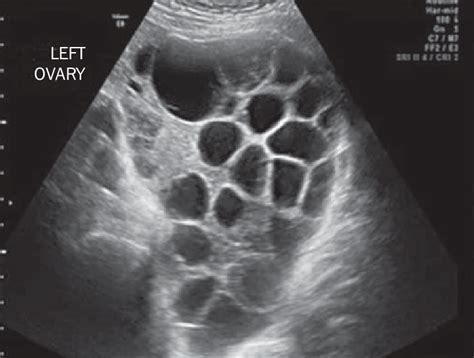 Pelvic Ultrasound Showing A Massive Theca Lutein Cyst In A Patient With