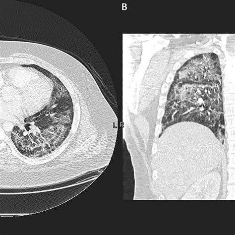 A Chest Ct Scan Axial View Lung Window Shows Diffuse Bilateral