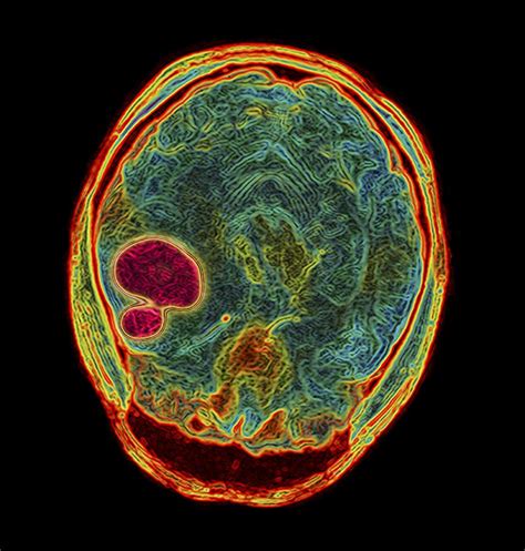 Brain Tumour Mri Scan Photograph By Pasieka Fine Art America