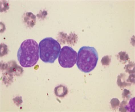 Photomicrograph Showing Monoblasts With Large Indented Nucleus