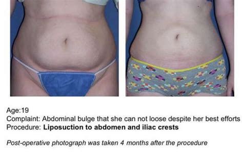 Liposuction Lipoplasty UF Health Plastic Surgery And Aesthetics