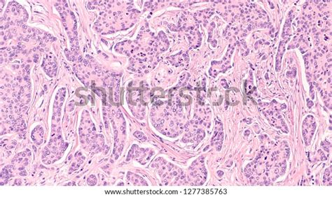 Breast Cancer Awareness Microscopic Image Photomicrograph Stock Photo