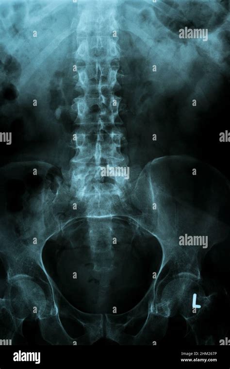 Columna Vertebral Y Pelvis De Un Cuerpo Humano En Una Imagen De Rayos X