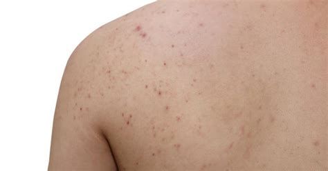 The Location Of Acne On Your Body Has A Secret Meaning Youll Want To
