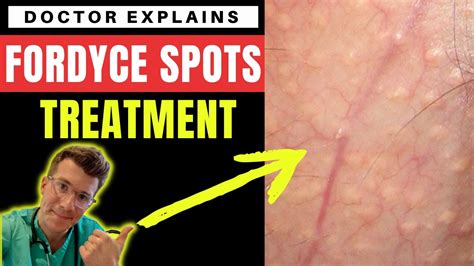 How To Treat Fordyce Spots Doctor Odonovan Explains Youtube
