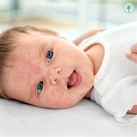 Alergia no bebê quais os sinais e como cuidar