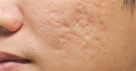 How To Get Rid Of Acne Scars Naturally Pimple Scar