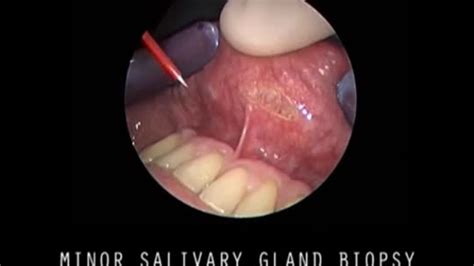 Minor Salivary Gland Biopsy Karl Storz