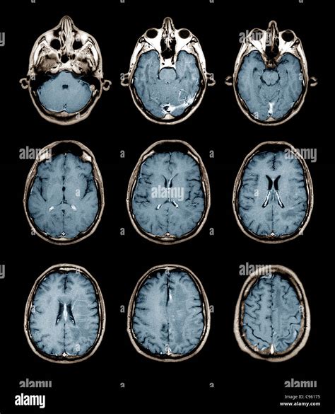 Normal Brain Mri Images Without Contrast