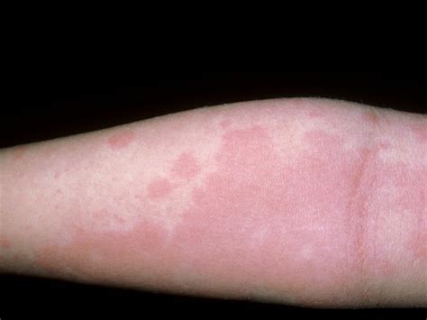 Hives As Related To Allergy Pictures