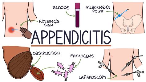 Understanding Appendicitis YouTube