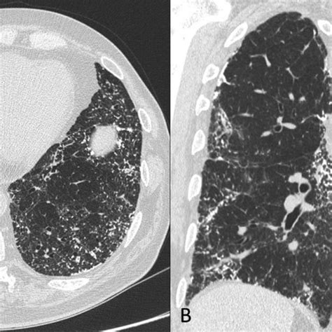 A B C High Resolution Computed Tomography Hrct Scan Lung A And