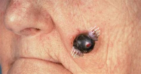 Is This Mole Cancerous Imgur
