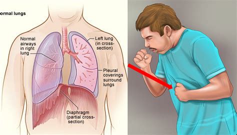Tuberculosis cómo reconocer las señales y los síntomas Medicina
