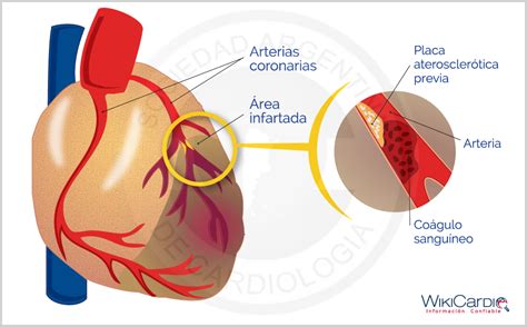 El Corazon Y Sus Patologias Infarto Agudo Del Miocardio Images