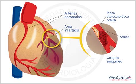Se trata de una afección que involucra. IAM (Infarto agudo de miocardio) - Dr. Javier Marino