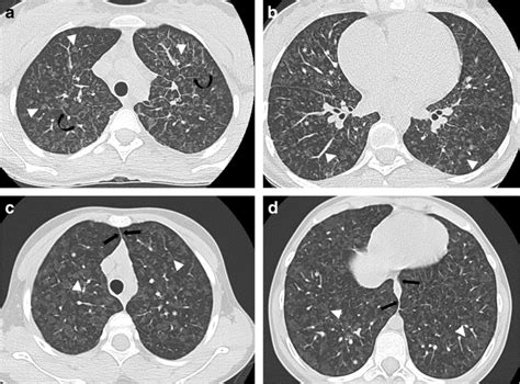 Axial Ct Angiography Lung Window Of Pulmonary Veno Occlusive Disease
