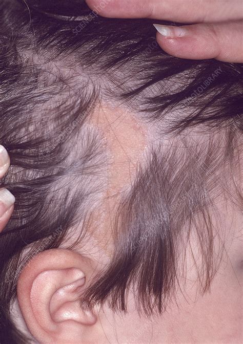 Sebaceous Naevus On The Scalp Stock Image C0531886 Science Photo