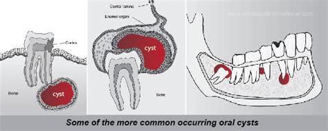 Wisdom Tooth Cyst On Gum