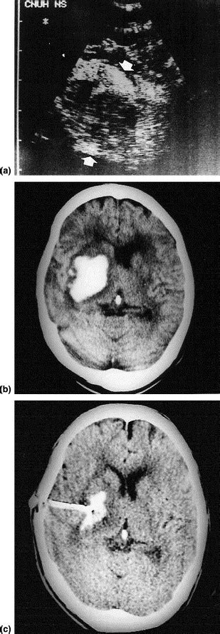 Ultrasound Guided Evacuation Of Spontaneous Intracerebral Hematoma In