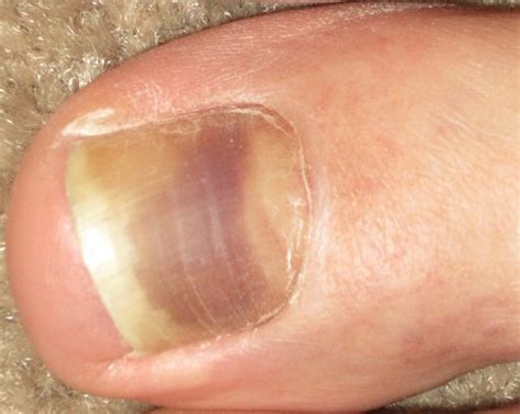 Toenail Discoloration Causes Risks And Ways To Treat Discolored