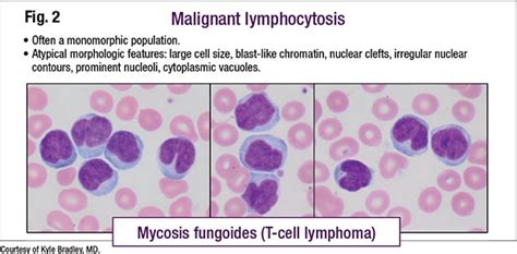 Lymphocytosis Distinguishing Benign From Malignant Cap Today