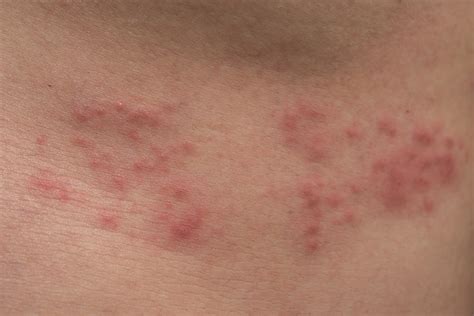 Herpes Symptoms On Body Closeup Of Body Skin With Herpes Zoster Shingles Stock Image Image