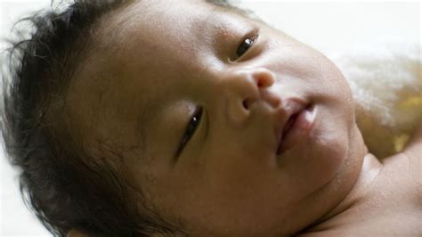 Circumcision Benefits Outweigh Risks Says Cdc Todays Parent
