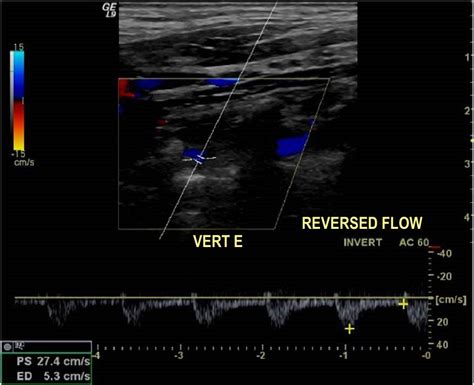 Figure From An Update On Doppler Ultrasound Of Vertebral Arteries