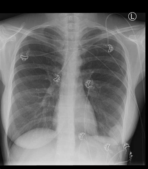 Pin On Chest Radiology