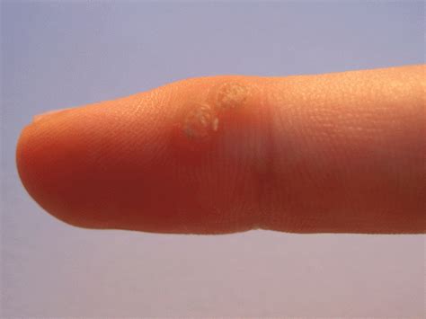 Viral Warts Nasgp