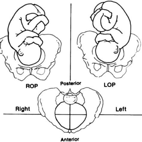 Fetal Occipito Posterior Op Position There Are Three Op Positions