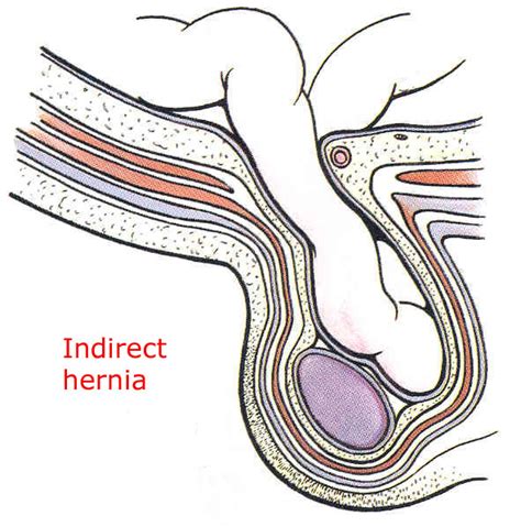 Where there is diagnostic uncertainty an ultrasound scan of the. learnmore: Hernia