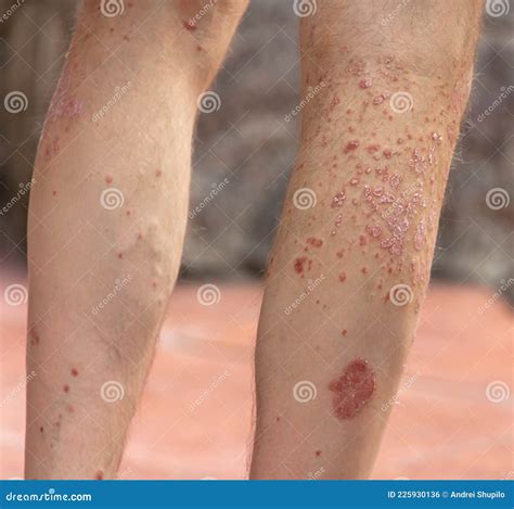 Fungus On The Skin Of The Leg Stock Photo Image Of Medical Care
