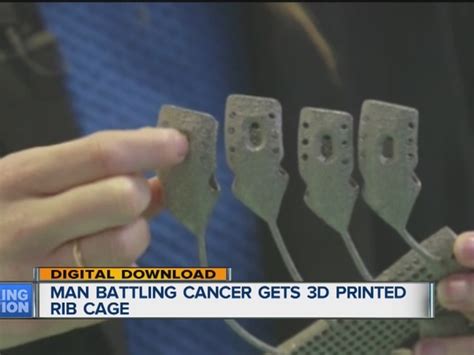Man Battling Cancer Receives 3d Printed Rib Cage