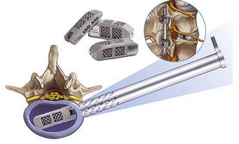 3d Printed Endolif Fusion Implant For Spinal Surgeries Receives Fda