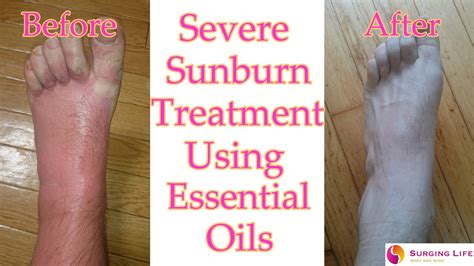 Essential Oils For Sunburn Treatment Mild To Severe Youtube