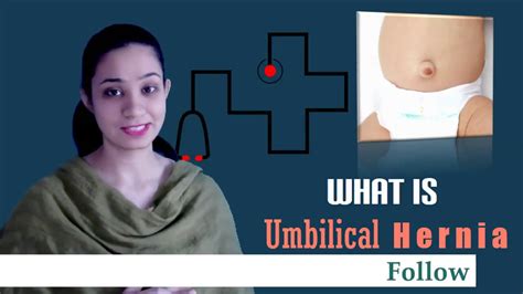 What Is Umbilical Hernia Symptoms Causes And Treatments For All