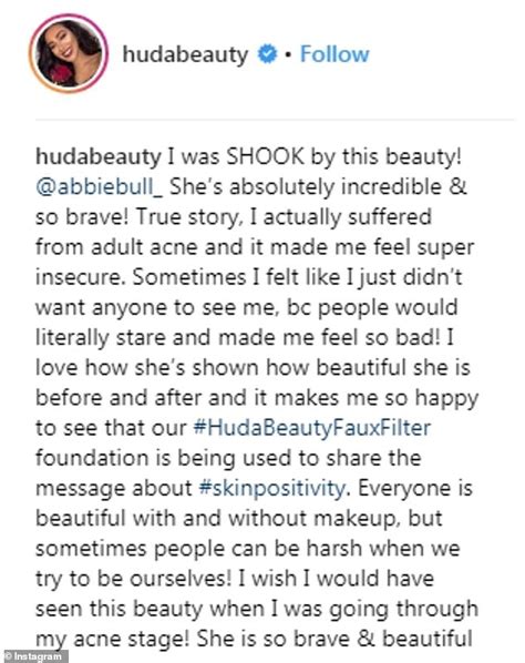 Instagram Goes Wild For Huda Beauty Foundation After Cystic Acne Sufferer Shares Before And