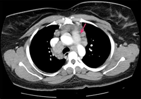 Ct Image Showing Several Non Calcified Lung Nodules And Widened