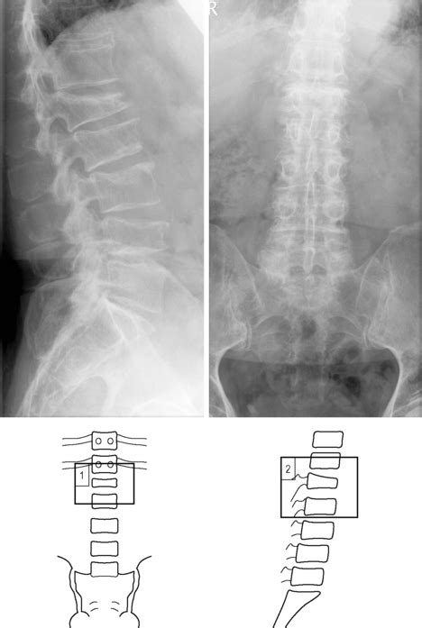 Vertebral Fracture Wedge Compression Radiology Key